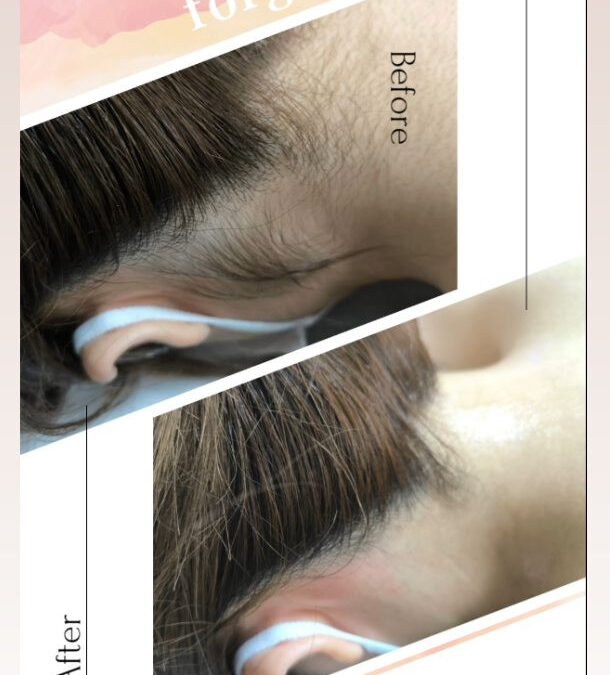 ✨うなじ脱毛✨