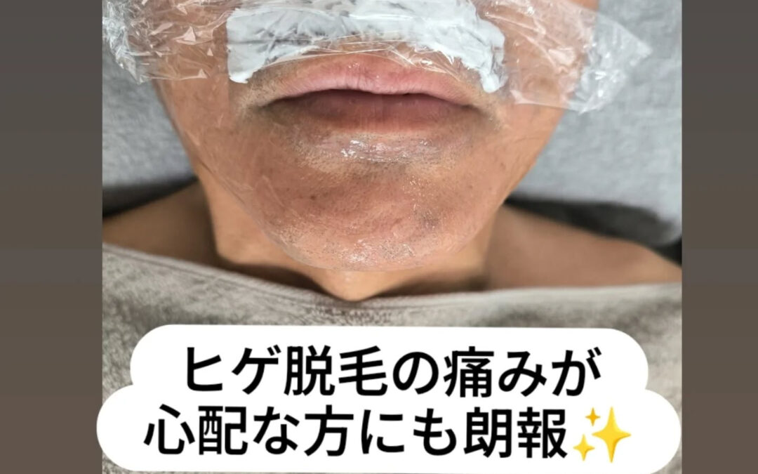 ヒゲ脱毛の痛みが心配な方にも朗報✨