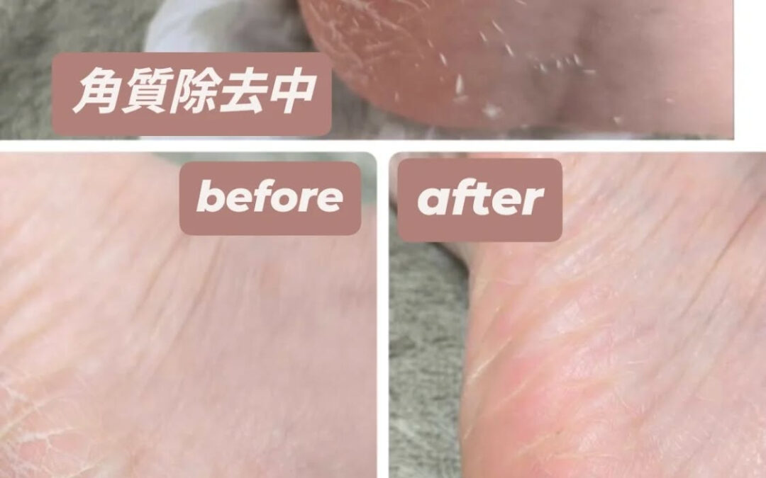 【秋冬限定 ⛄️❄️✨かかと角質ケア】