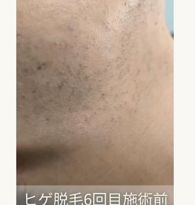 6回目のヒゲ脱毛✨⁡