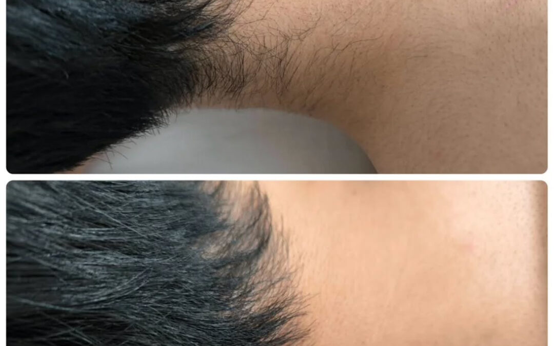 男性の襟足脱毛 Before→After⁡